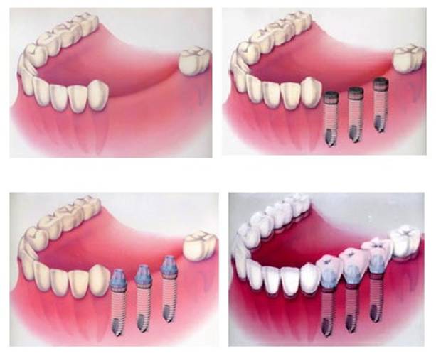 implantacziya1.jpg